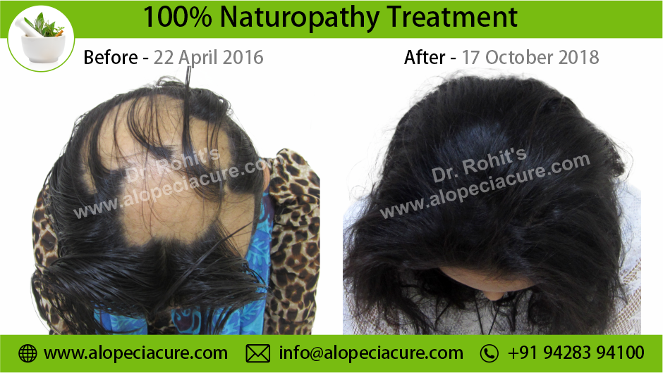 alopecia areata treatment Pune